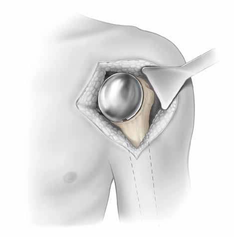 Proper alignment at back-table assembly will ensure that the fins of the Humeral Cage can be visualized while implanting in the humerus, which will be necessary if the Tamp was used to