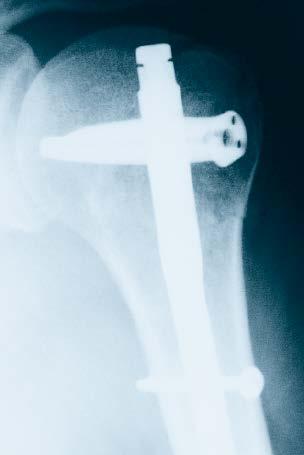 fracture treated with Titanium Proximal Humeral Nail and Titanium Spiral Blade