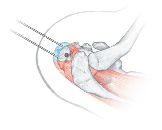 Open the proximal humerus The surgical approach to the proximal humerus should be considered carefully. The anterior acromial approach is recommended to minimize damage to the rotator cuff.