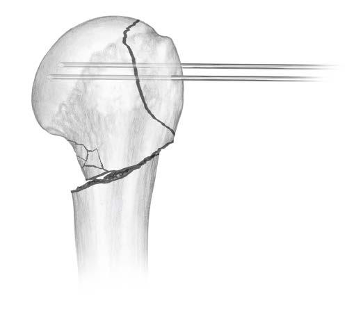 The lateral acromial approach will also position the entry site posterolateral resulting in varus displacement of a proximal fragment and the possible fracture of the entry site if the fracture is