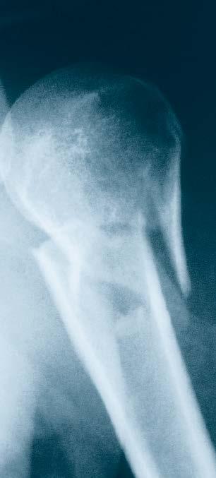 Indications Indications for the Titanium Solid Humeral Nail System include: Diaphyseal fractures of the humeral shaft Fractures of the