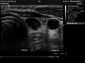 Minimally invasive parathyroidectomy Predicting single gland disease Case 1: 46yo woman found to have elevated serum