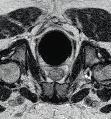 Right: MRI image (T2W- TSE) of the same patient using the integrated T/R body coil.