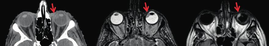 contrast Target visualization and definition Based on the image information, delineation of a glomus tumor in a head & neck patient differs