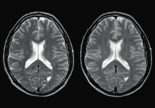 Options for enhanced imaging SmartExam Brain Philips SmartExam is a powerful automated technology that provides reproducible, consistent clinical images with identical slice