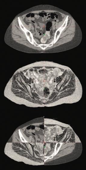 Top: CT image Center: MR image Bottom: CT and MR registration with: Automated rigid registration.