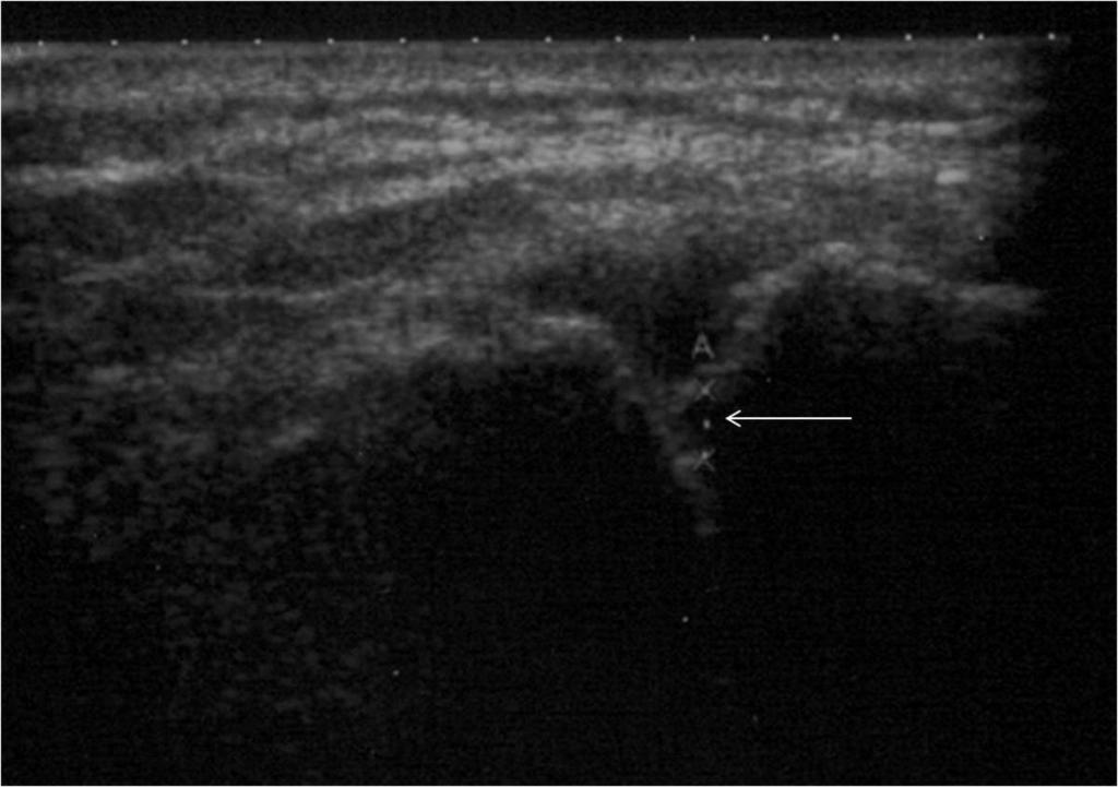 Fig. 1: In the ultrasonography image a small subchondral cyst (arrow) is seen in the clavicular side of the ACJ.