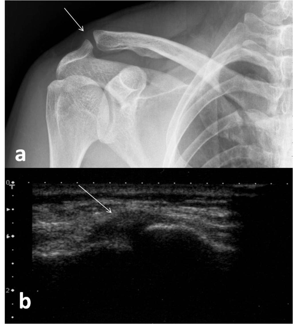 Fig. 2: In comparison to anterior-posterior plain radiograph of the right shoulder(a), capsular
