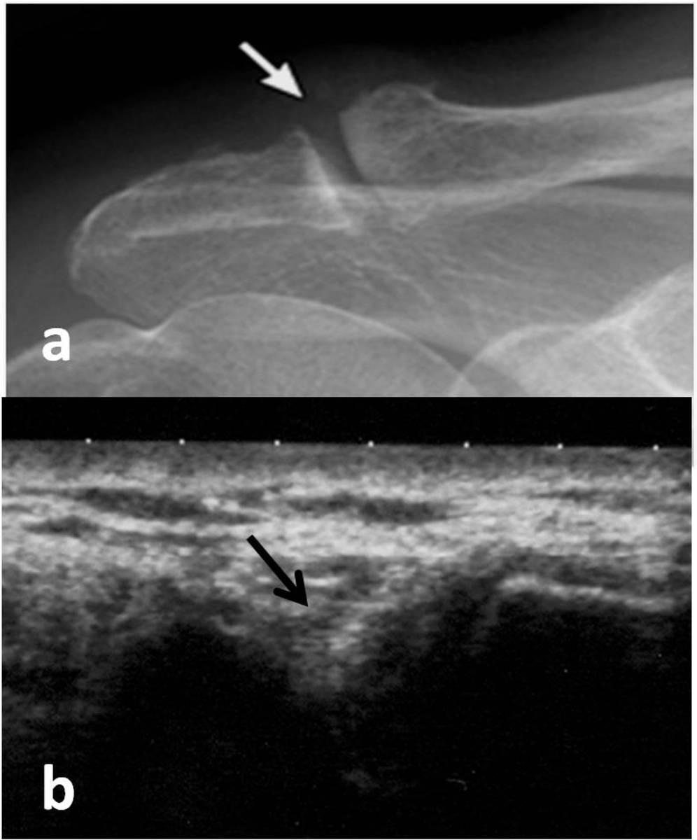 Fig. 3: Plain radiograph in anterior-posterior projection (a) and ultrasonographic image (b)of same