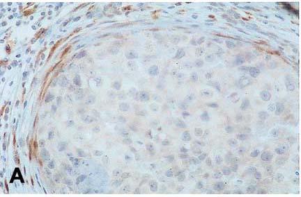 28 accumulation of p16 INK4A can be used for identification of a subset breast tumors with accelerated proliferation and other unfavorable properties.