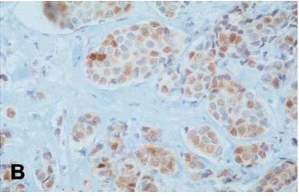 7) and it is shown that cytoplasmic p16 INK4A overexpression in breast cancer was associated with a highly malignant tumor phenotype 3.