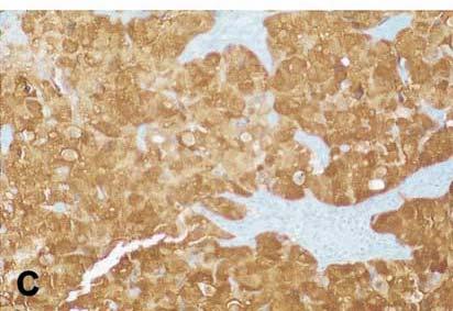 Cytoplasmic localization of p16 INK4A is observed in different types of cancers and may be a good prognosis for tumorigenesis and malignancy. Figure 7 p16 INK4A immunohistochemistry.
