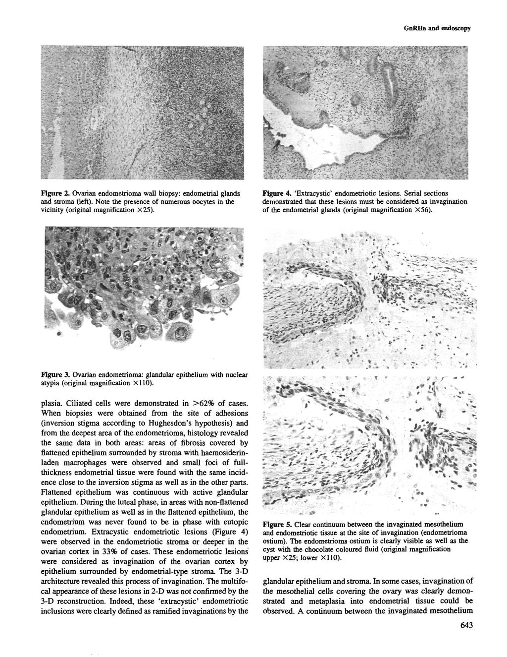 GnRHa and eodoscopy Figure 2. Ovarian endometrioma wall biopsy: endometrial glands and stroma (left)- Note the presence of numerous oocytes in the vicinity (original magnification X25). Figure 4.