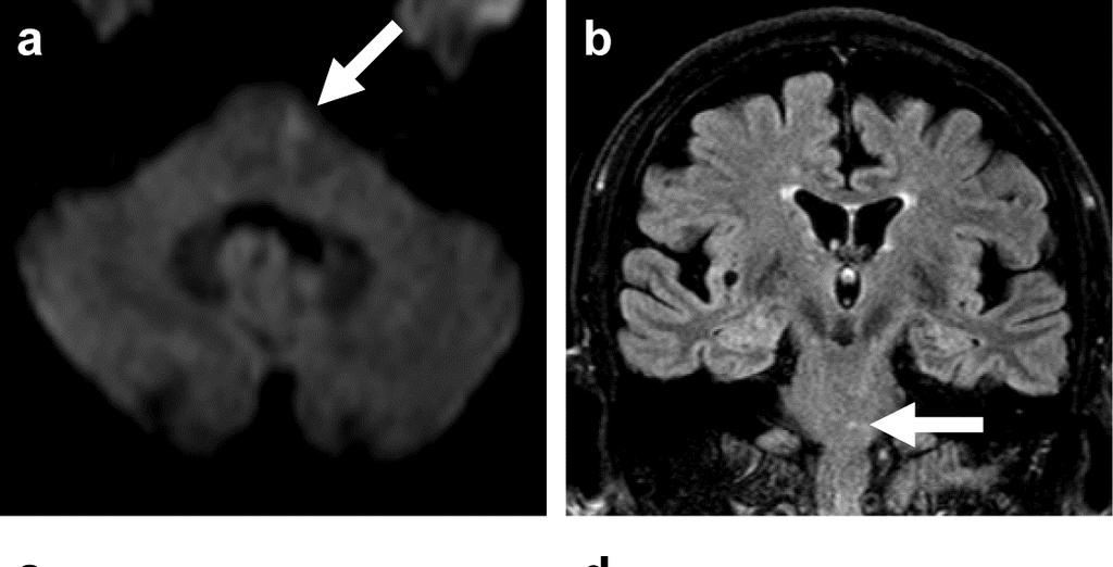 Legend to Figure 1 Axial diffusion-weighted (a) and coronal FLAIR brainstem MRI (b) showing an ischemic lesion in the left caudal ventral paramedian pons (arrows).