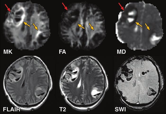 Diffusion Kurtosis Imaging of the Brain These findings would suggest that inclusion of kurtosis data could complement traditional diffusion imaging to provide a more accurate model for infarction and