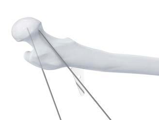 Osteotomy Procedure 1. With a Kirschner wire the anteversion of the neck of the femur is defined.