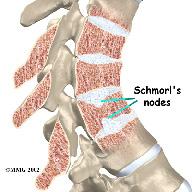 slightly throughout life both in women and men. Scheuermann's disease causes the thoracic kyphosis to angle too far (more than 45 degrees). each disc and vertebral body is a vertebral end plate.