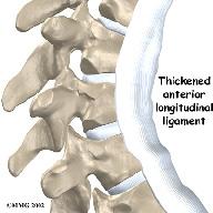 This ring surrounds and protects the spinal cord. In Scheuermann's disease, the front of the vertebral body becomes wedge-shaped, possibly from abnormal growth.