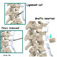 spread apart so the surgeon can reach the spine better. The surgeon operates on the front of the spine through the chest cavity. A section of the anterior longitudinal ligament is cut.