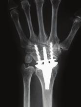 Introduction The ReMotion Total Wrist System implant is a prosthesis