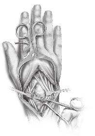 This reflection of the extensor retinaculum (rather than a central division) is recommended so that the distal 1/3 can be used to reinforce the dorsal joint capsule if necessary (Fig. 1B).