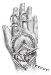 A rectangular shaped wrist flap is reflected from proximal to distal to expose the proximal and distal carpal rows.