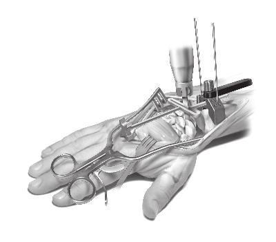 Insert the PGT Carpal Cutting Guide into the PGT Guide and tighten in place.