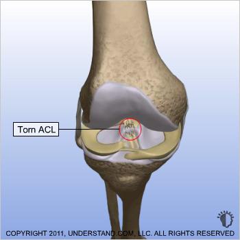 Hamstring Graft Introduction The anterior cruciate ligament (ACL) is one of four ligaments that are crucial to the stability of your knee.