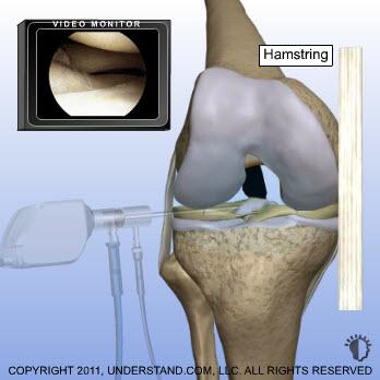 ACL Removal and Hamstring Modification A surgical instrument is inserted into the joint and the torn ACL is removed.