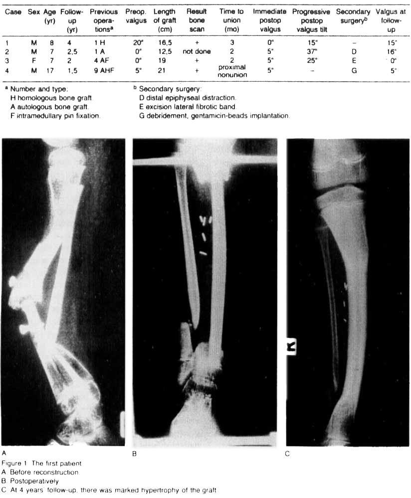 426 Acta Orthop Scand 1988;59(4):425-429 hypertrophy of the graft with a well-formed medullary canal. An increasing valgus malalignment of the tibia developed in these children (Table 1).