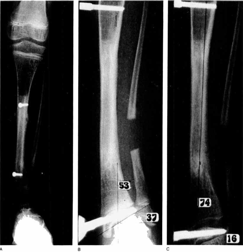 Ada Orthop Scand 1988;59(4):425-429 427 ment at the proximal junction of the graft that had progressed over 18 months to 25", and after a fall the patient sustained a fracture on that side.