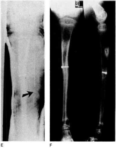 After correction of the valgus deformib with partial exc\sion of a lateral fibrotic band (arrow). F. 10 weeks after correction the fracture had united.
