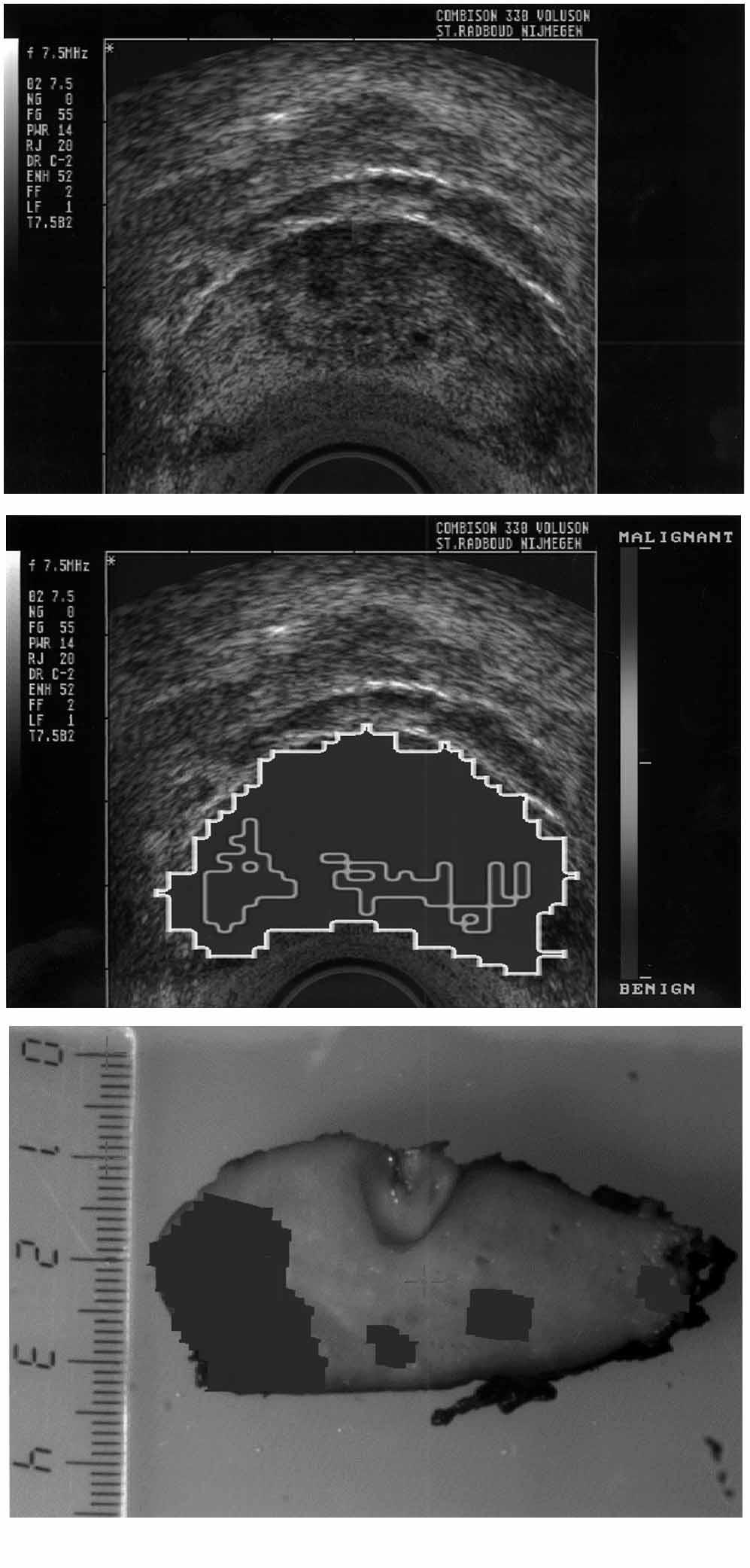 58 Figure 1 (A) Prostate ultrasound image; (B) Corresponding AUDEX analysis (inner marked area suspicious for malignancy); (C) Corresponding pathology (dark area is malignant).