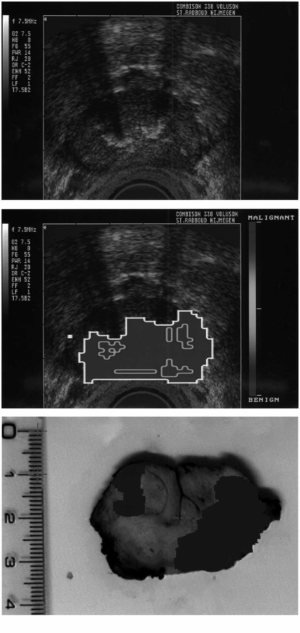 59 Figure 2 (A) Prostate ultrasound image; (B) Corresponding AUDEX analysis (inner marked area suspicious for malignancy); (C) Corresponding pathology (dark area is malignant).