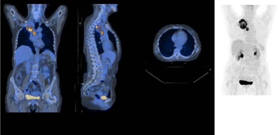 PET in Oncology Functional imaging technique : Many tumour cells have increased glycolysis rate, leading to increased FDG uptake PET-CT images from radiotherapy planning