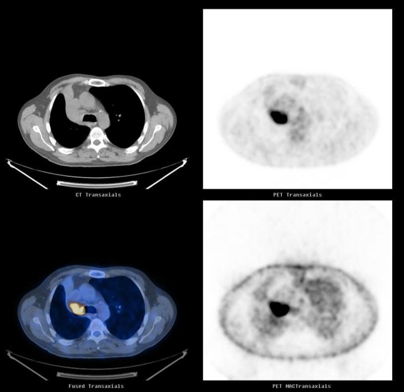 Why use PET/CT in RT Planning in NSCLC? CT current gold standard for GTV definition in the radical treatment of NSCLC with radiotherapy.