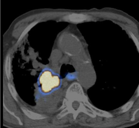 PET/CT in RTP Atelectasis Significant potential benefit by reducing RT volumes However: False positive uptake in postobstructive