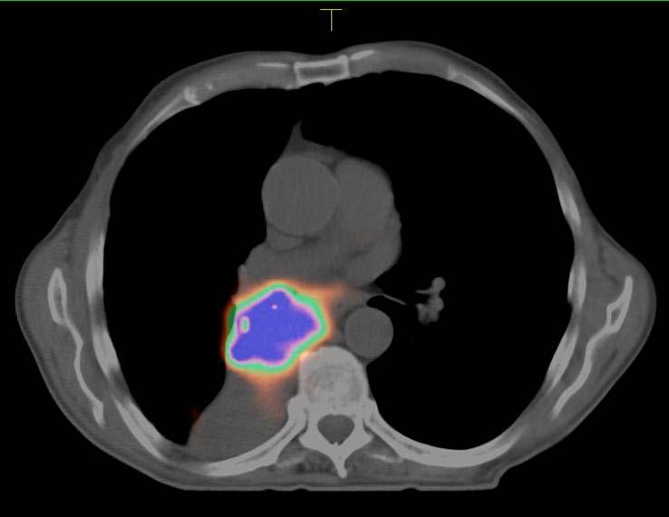 Using PET/CT for RT Planning