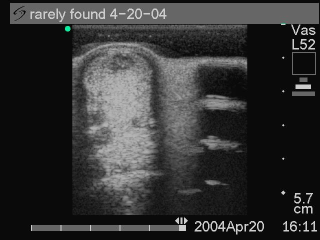 Ultrasound scan images during this primary clinical evaluation showed a very concise 25 to 30% core lesion of the superficial digital flexor tendon (SDFT).