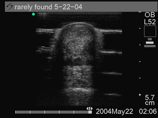 Clinical Evaluation Ultrasound scan imaging showed a transition to a more uniform echogenicity with a complete reduction of the SDFT core lesion to a well defined tendon cell, fibrin and collagen