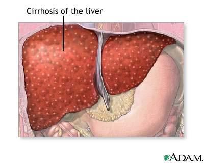 What is Cirrhosis? Cirrhosis of the liver is a degenerative disease where liver cells are damaged and replaced by scar formation.