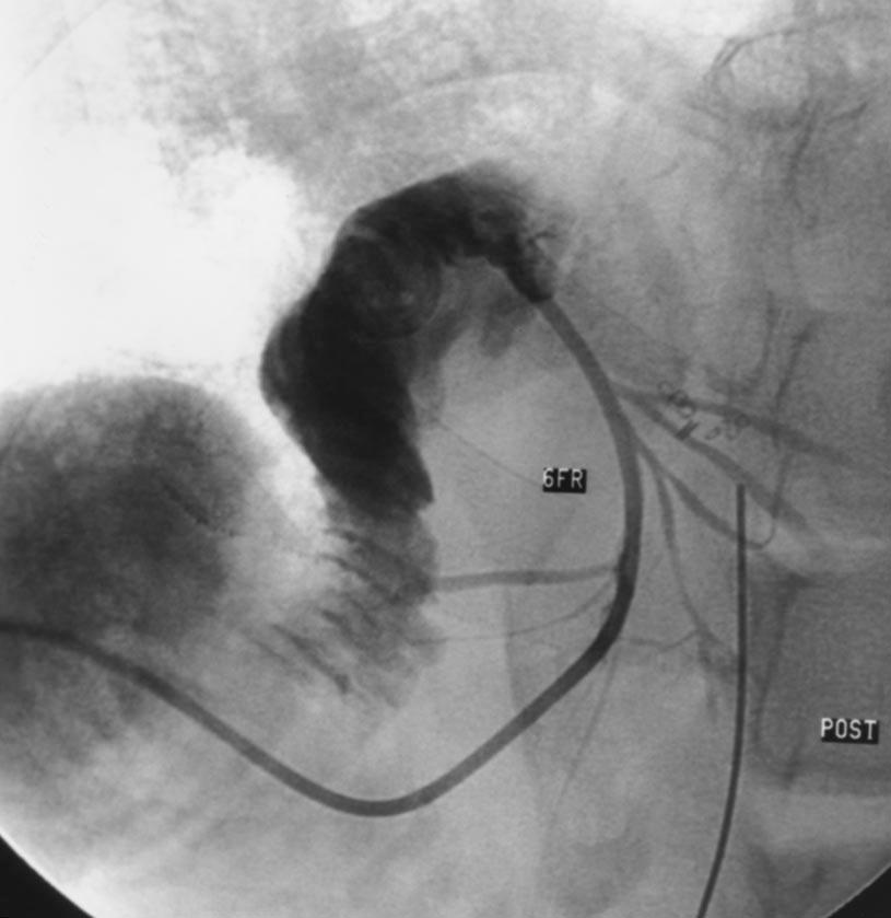 Left lateral segment, whole-liver, and split-liver left-lobe transplant grafts were included in the study.