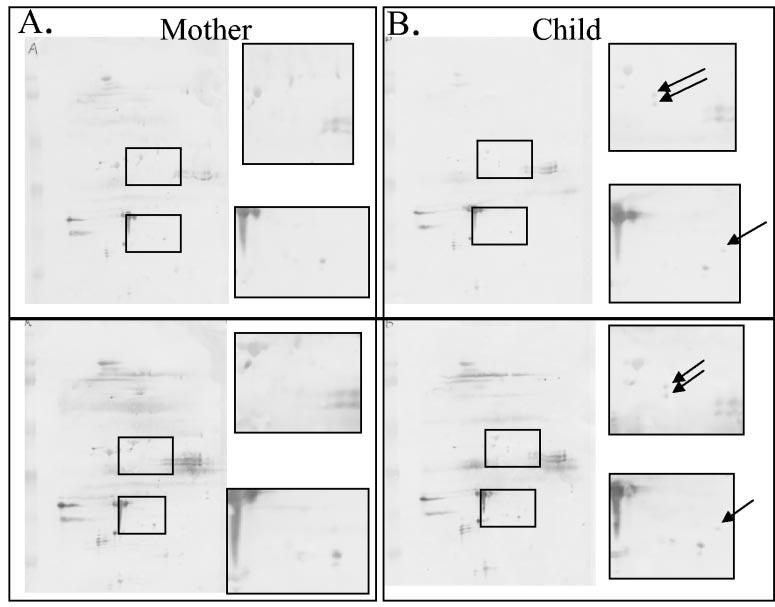 VOL. 43, 2005 DIAGNOSIS OF TOXOPLASMOSIS BY ANALYSIS OF IgG PROFILES 713 FIG. 3. Representative 2DIB results from the same mother-child pair illustrate the reproducibility of this test.