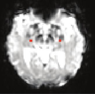 572 Brain 2012: 135; 569 581 E. R. Kenny et al. Hippocampus Posterior cingulate cortex Precuneus Primary visual cortex Figure 1 Seed regions overlaid on the functional images.