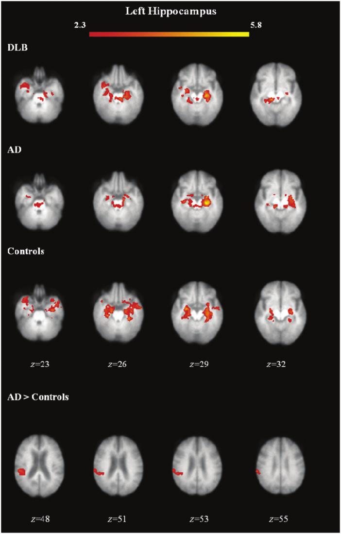 574 Brain 2012: 135; 569 581 E. R. Kenny et al. Figure 2 Functional connectivity maps for group means and group differences with the left hippocampus.