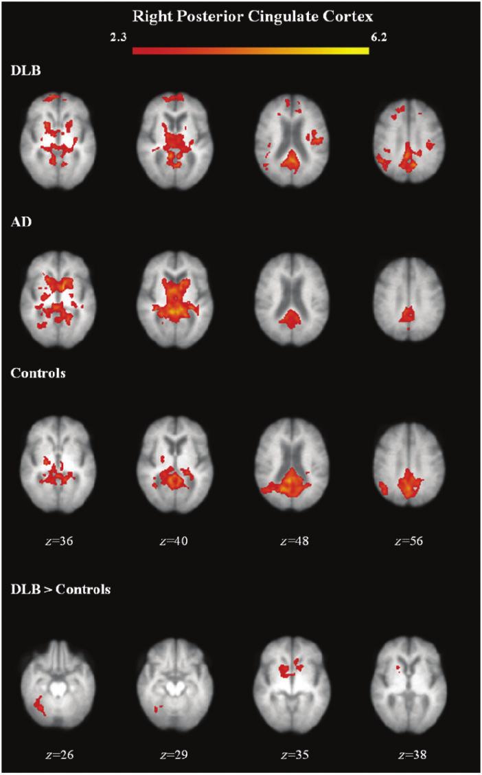 576 Brain 2012: 135; 569 581 E. R. Kenny et al. Figure 3 Functional connectivity maps for group means and group differences with the right posterior cingulate cortex.