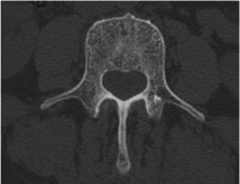 scan at the lumbosacral level, revealing multiple discrete osteolytic and osteoblastic lesions and diffuse osteopenia, relating to the vertebrae, sacrum and iliac bone.