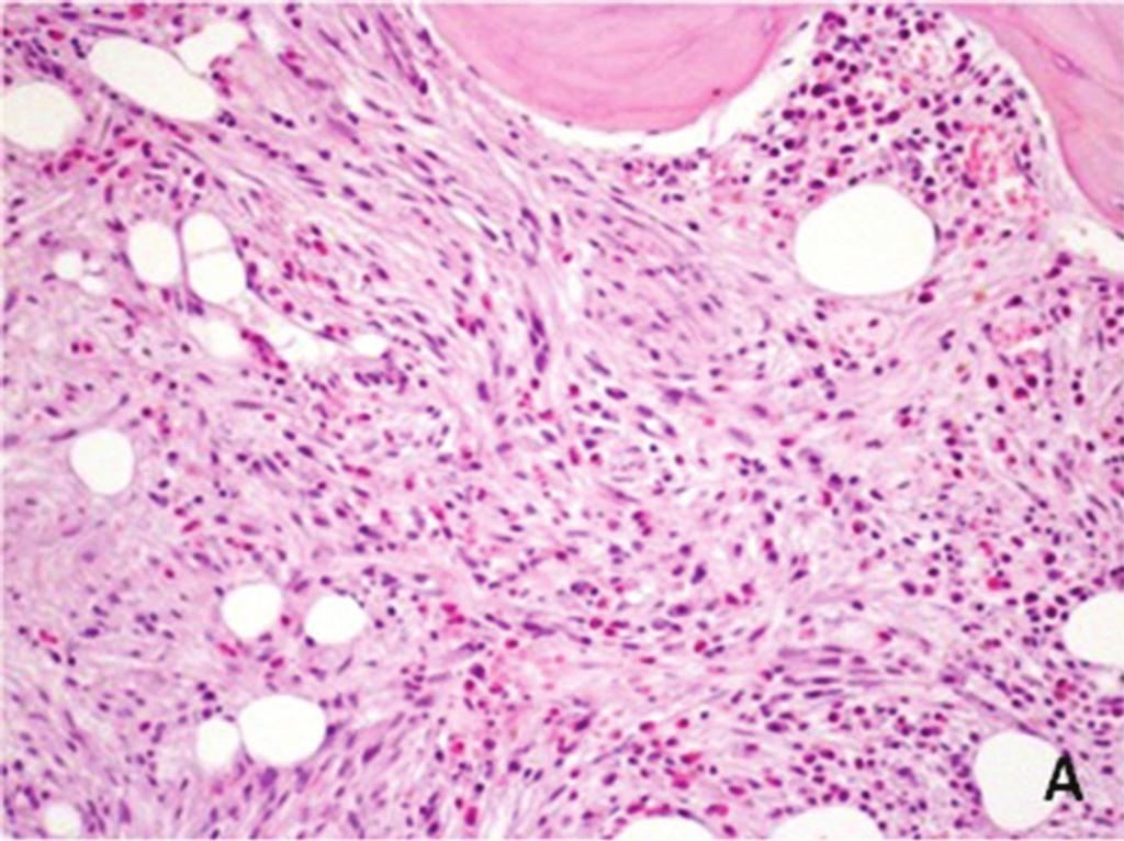 Indolent systemic mastocytosis limited to the bone: a case report and review of the literature CASE REPORT excessive proliferation of neoplastic MCs that accumulate in one or more organs,