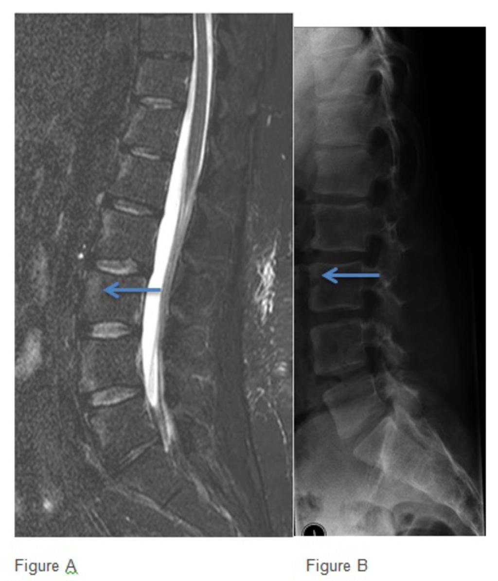 Fig. 5: Figure A. "Shiny corners" due to marrow oedema at the vertebral corners (blue arrow) on this STIR lumbar spine image of a case of Ankylosing spondylitis.