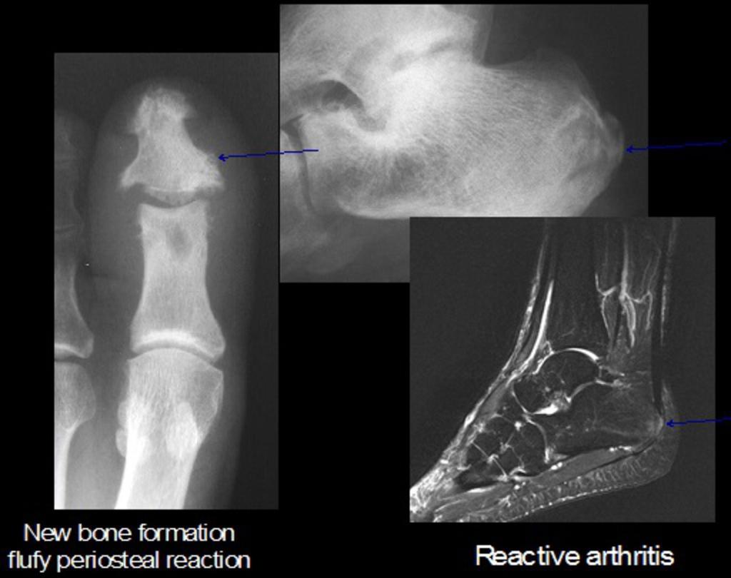 Fig. 6: Reactive arthritis: Fluffy new bone formation and entheseopathic changes at